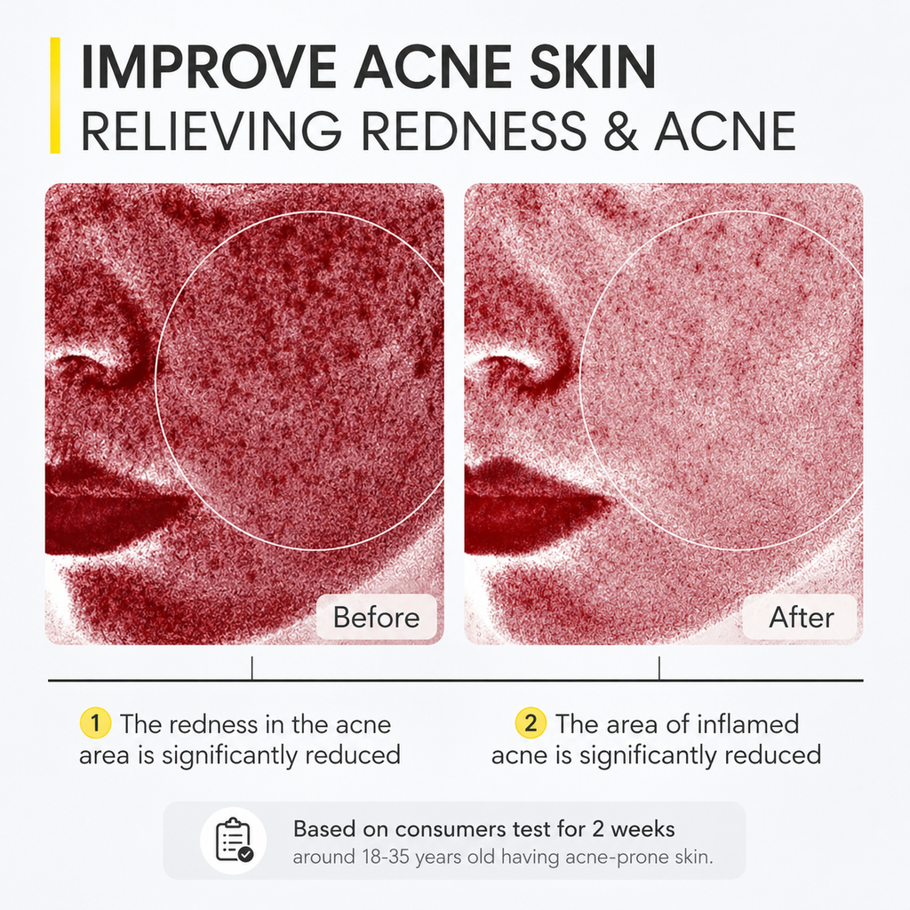 Skinever ClearFreeze Acne Mask